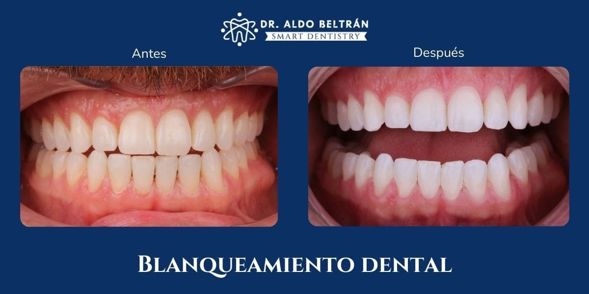 Blanqueamiento dental en clínica y guardas para el hogar