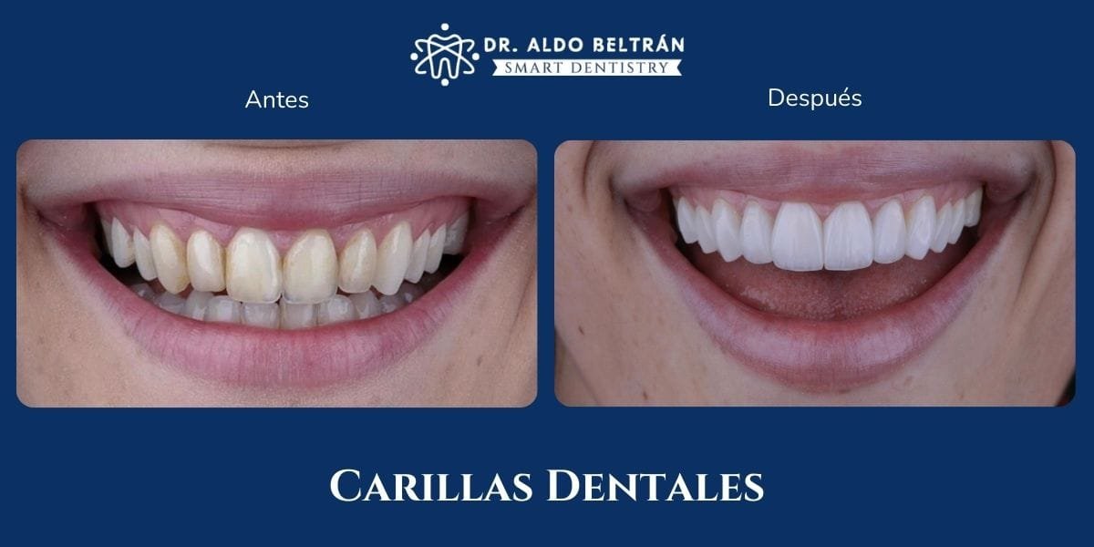 Todo sobre las Carillas Dentales