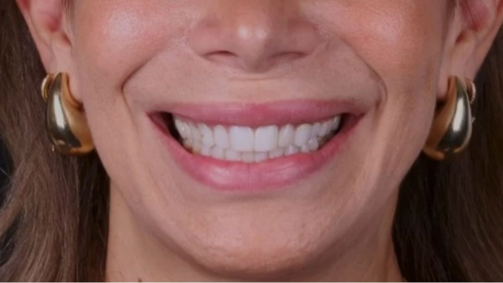 Carillas dentales en monterrey simulación 2D (Después) Carillas dentales en monterrey simulación 2D (Después)