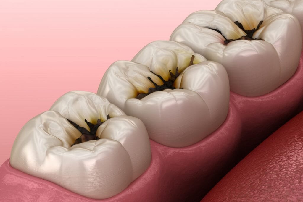 Tratamiento de Caries en Monterrey