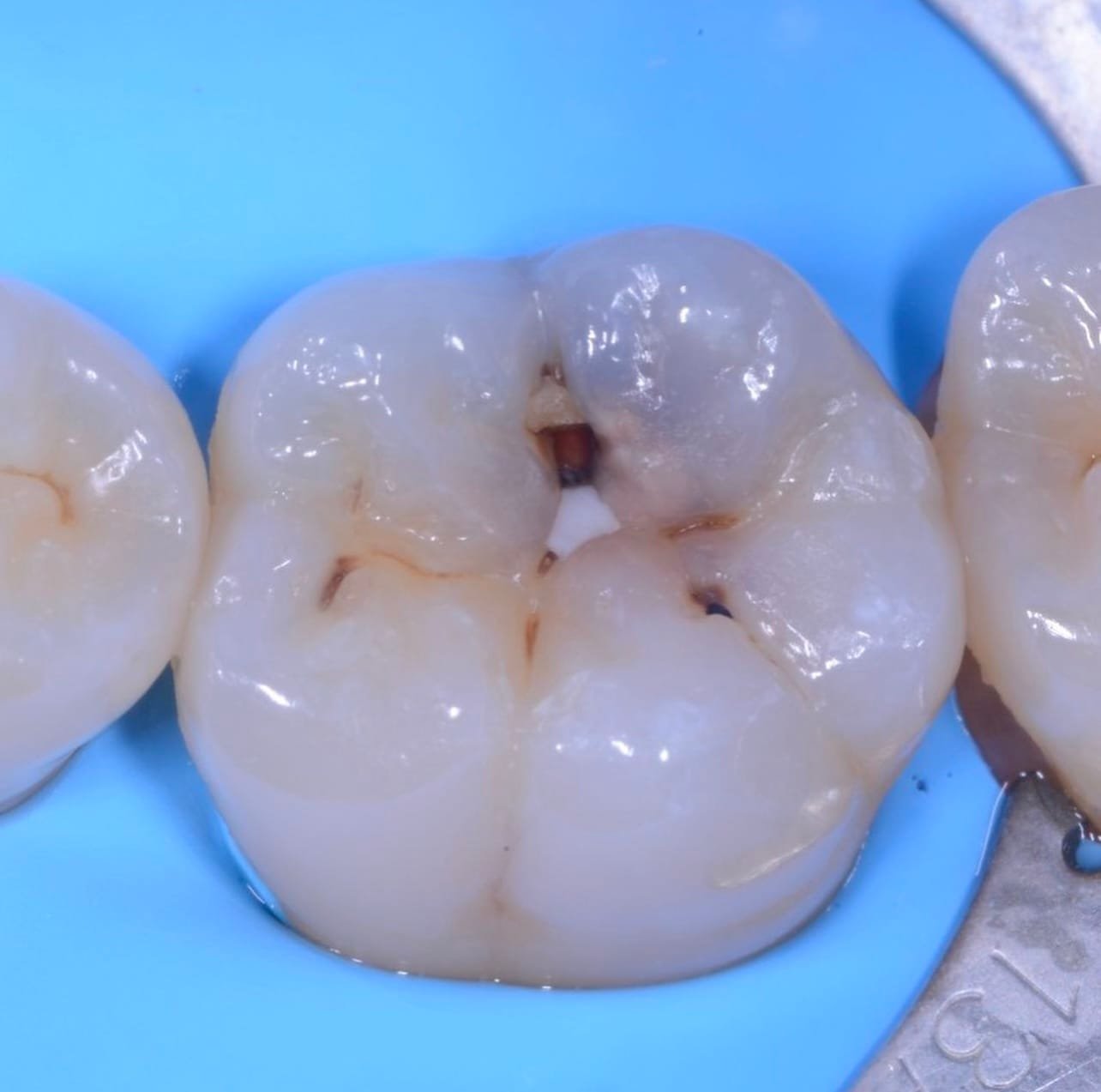 Tratamiento de caries en Monterrey y San Pedro Garza García