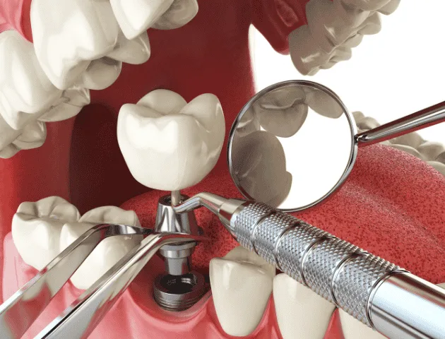 Proceso de colocación de implantes dentales en San Pedro
